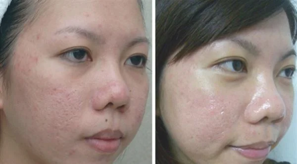 做去痘疤失败修复治疗效果怎么样?效果保持时间多久?