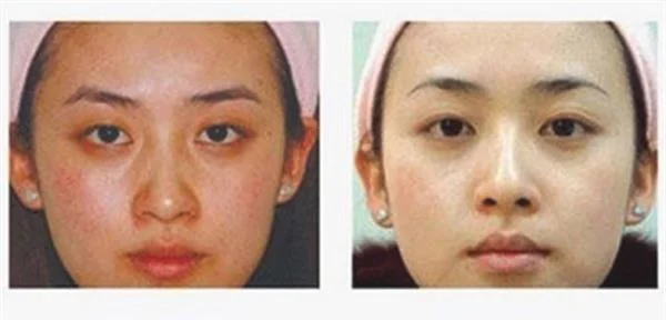 果酸换肤去眼角细纹手术效果好不好?