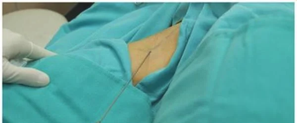 剥离法去腋臭手术术后护理？