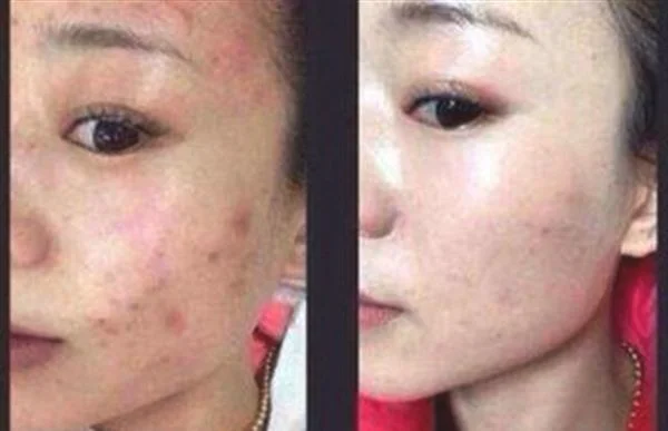 袪青春痘手术注意事项是什么？