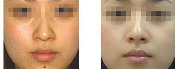 爱贝芙去痘疤手术术后护理？