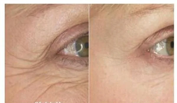 做爱贝芙去鱼尾纹治疗效果怎么样?效果保持时间多久?