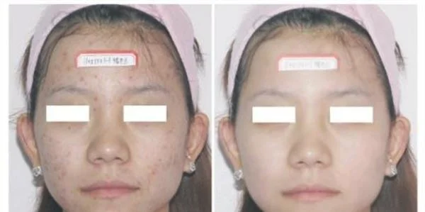 光子祛痘手术的方法是什么？