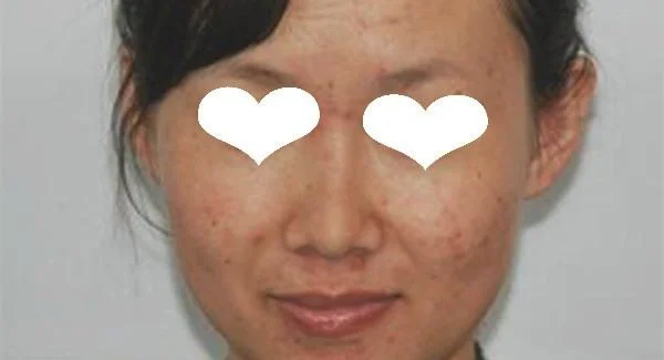 做针清去青春痘手术注意事项是什么？