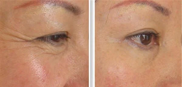 做爱贝芙去眼角细纹价格