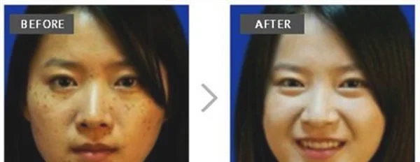 做光子治疗去黄褐斑费用大概需要多少