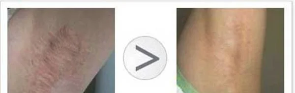 切除法去腋臭手术注意事项是什么？