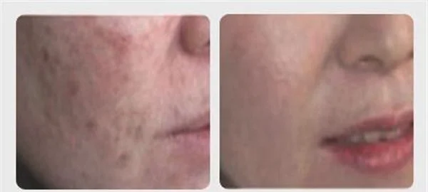 做爱贝芙去痘疤手术多少钱?