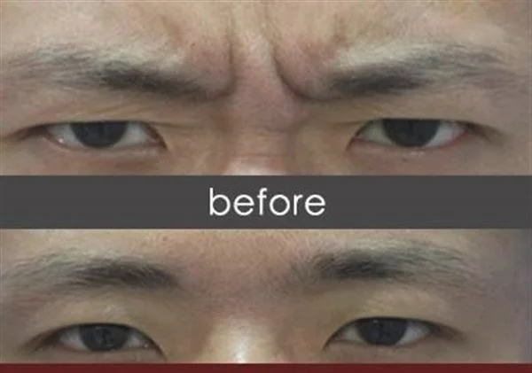做微晶磨皮去眉间纹治疗效果怎么样？效果保持时间多久？