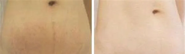 做微晶去妊娠纹治疗效果怎么样？效果保持时间多久？