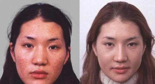 做激光去雀斑治疗效果怎么样？效果保持时间多久？