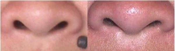 做E光点痣治疗效果怎么样?效果保持时间多久?