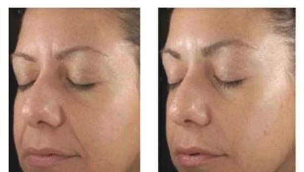 做果酸换肤去眼角细纹手术多少钱？