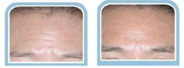 自体脂肪去抬头纹优点是什么？