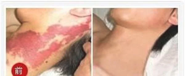 去胎记手术安全吗？