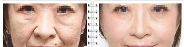 内窥镜除皱去鱼尾纹手术效果好不好？