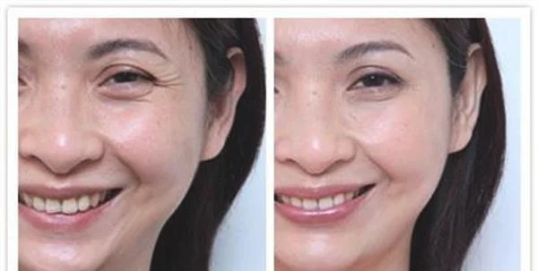 做玻尿酸去鱼尾纹手术多少钱?