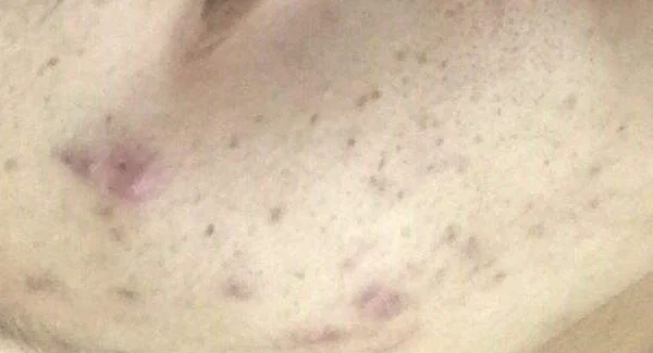 做爱贝芙去痘疤手术注意事项是什么？
