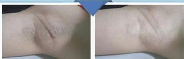 做微波去除腋臭治疗效果怎么样？效果保持时间多久？