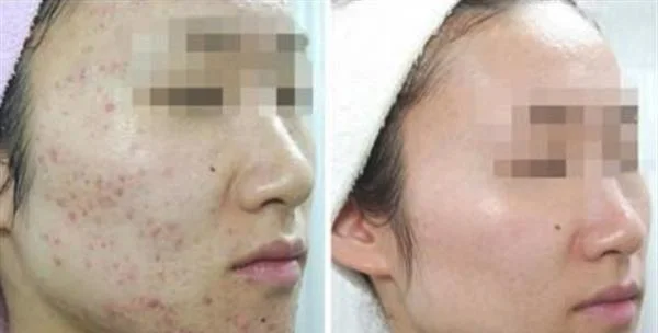 做E光去痘印治疗效果怎么样？效果保持时间多久？
