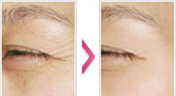 做内窥镜除皱去鱼尾纹价格