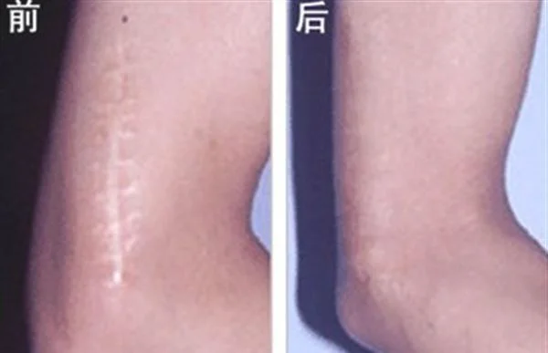 手术疤痕修复有哪些优点？