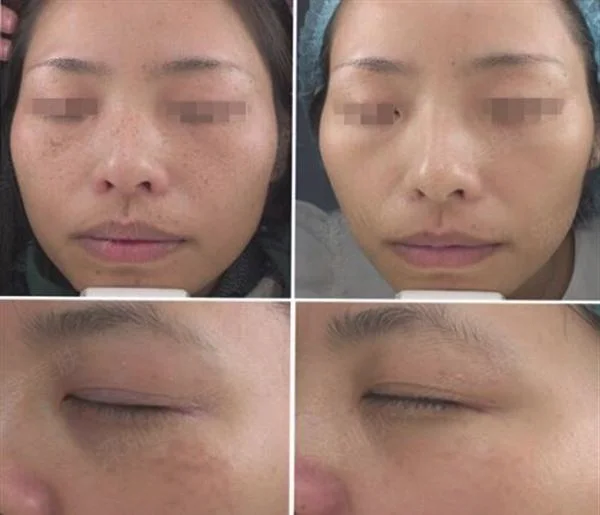 做激光去雀斑多少钱