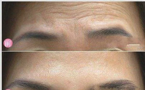 做激光除眉间纹价格要多少