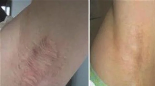 剥离法去腋臭手术注意事项是什么？