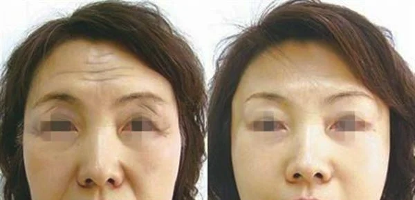 做去法令纹费用多少钱