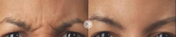 做爱贝芙去眉间纹手术多少钱?