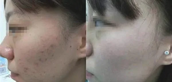 做射频微针去痘疤多少钱