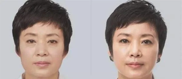 做热提拉手术多少钱？