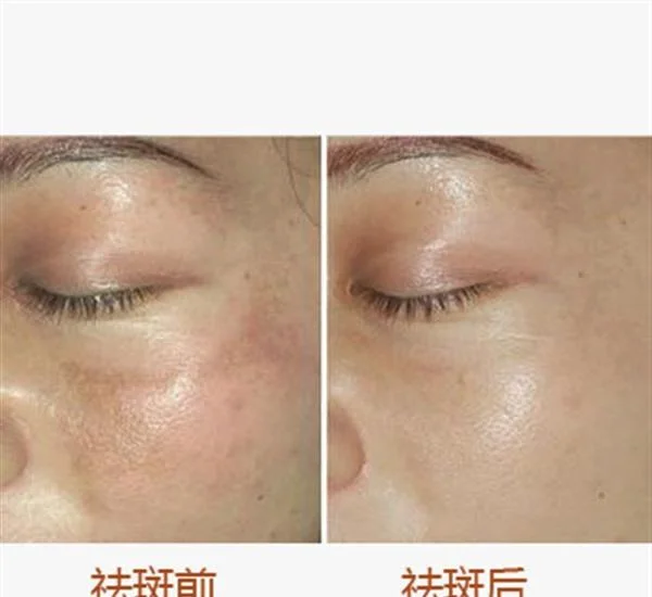 做去黄褐斑费用要多少