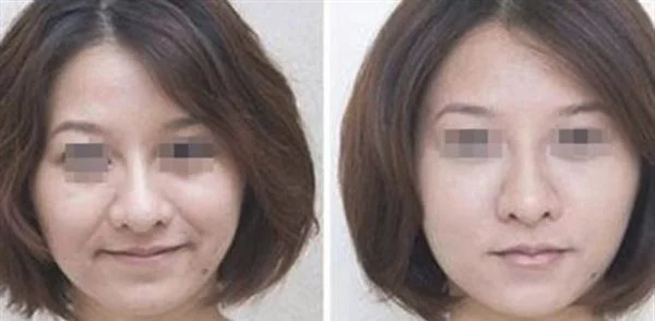 做自体脂肪去法令纹价格要多少