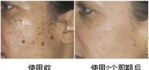 做去黑痣失败修复多少钱