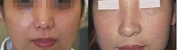 做光子嫩肤治疗效果怎么样？效果保持时间多久？