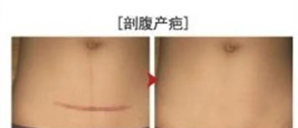 剖腹产疤痕修复手术效果好不好？