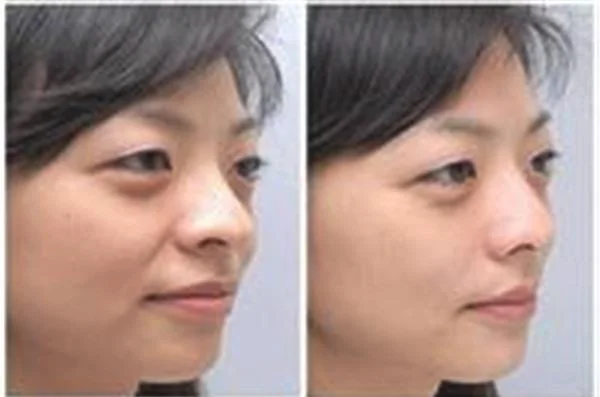 微晶磨削去法令纹不适合哪种人？