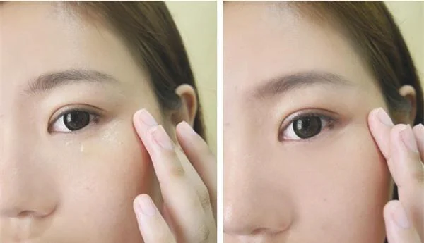 脉冲光去眼角细纹效果如何？