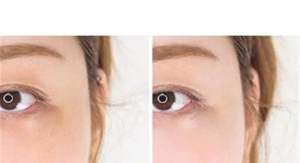 做激光去眼角细纹价格多少钱