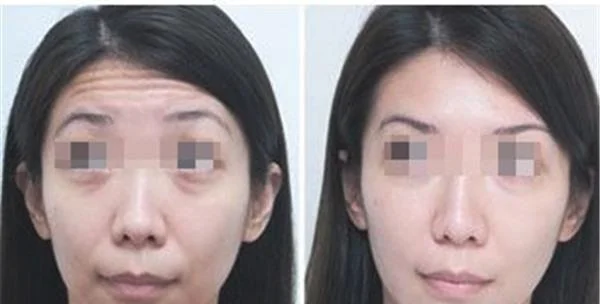 额颞部除皱去抬头纹优点是什么？