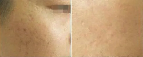 做微晶磨削去黑痣费用大概需要多少