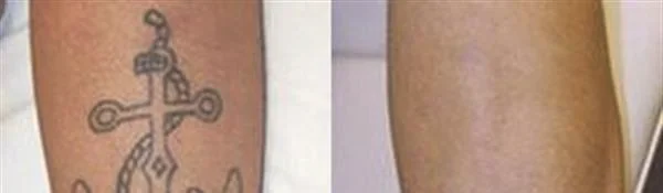 做空针密文褪色法去纹身治疗效果怎么样？效果保持时间多久？