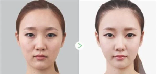 做水光娃娃手术多少钱？
