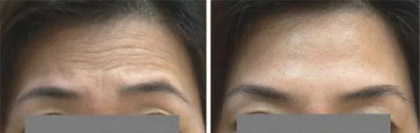 做E光除抬头纹价格多少钱