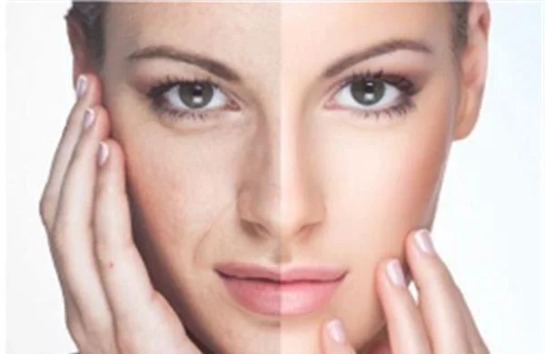 爱贝芙去法令纹适合哪种人？