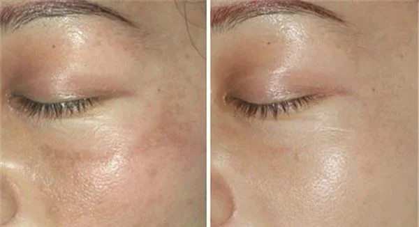 做射频祛斑价格