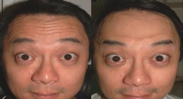 做去抬头纹失败修复价格贵吗