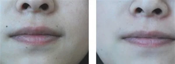 E光点痣手术安全吗？
